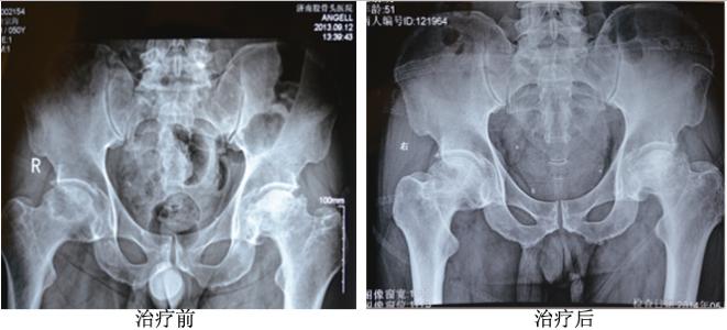 激素,酒精,外伤性,是不是造成股骨头缺血性坏死的根源?