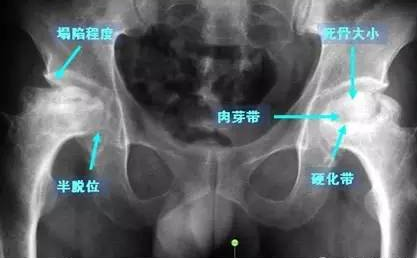股骨头坏死老是治不好原因出在这里!