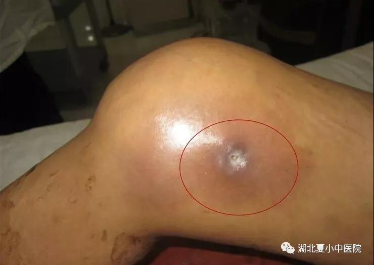 22岁女孩膝关节结核伴寒性脓肿康复历程
